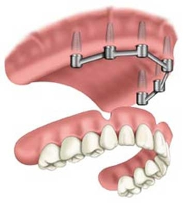 implantdenture2