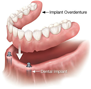 implantdenture1