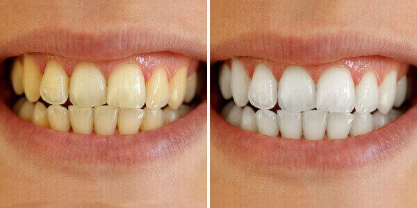 whiteningbeforeandafter